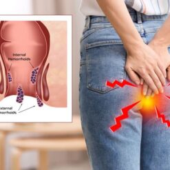 hemorrhoids Healer